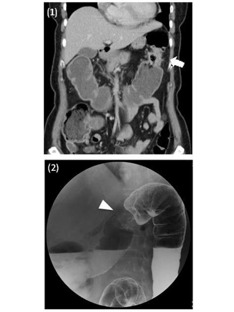 Apple-core Lesion of Colon Adenocarcinoma by Barium Double Contrast ...