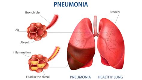 Pneumonia: Symptoms, Causes, Treatment and Diet – NutritionFact.in