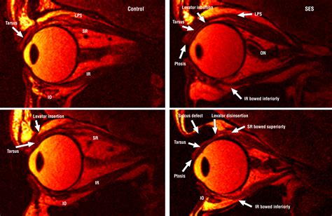 Sagging Eye Syndrome: Connective Tissue Involution as a Cause of Horizontal and Vertical ...