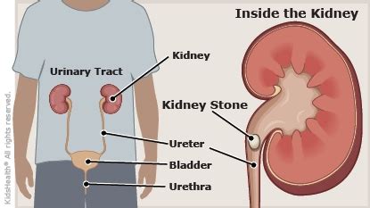 Kidney Stones (for Teens) - Humana - Louisiana