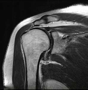 mri-shoulder-supraspinatus-tendon-full-tear-rupture-10 - MRI at Melbourne Radiology Clinic