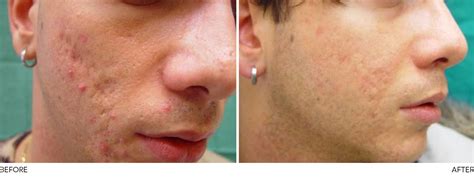 Adult Acne & Scarring | Aesthetic Skin Clinic Burnley Lancashire