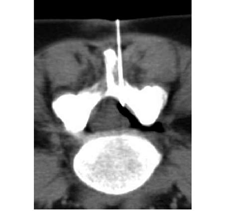 CT epidurogram: R with air. | Download Scientific Diagram