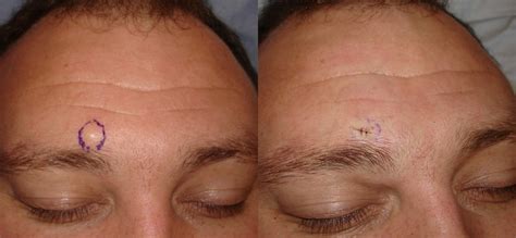 Cyst Removal Prices, Costs | Skin Surgery Laser Clinic