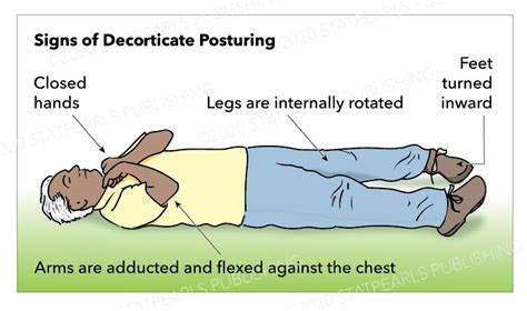 Decerebrate and Decorticate Posturing | Treatment & Management | Point of Care