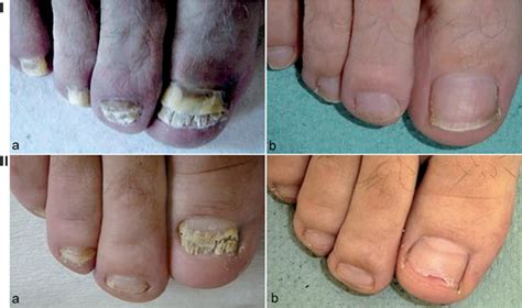Efficacy of Fluconazole at a 400 mg Weekly Dose for the Treatment of Onychomycosis | HTML | Acta ...