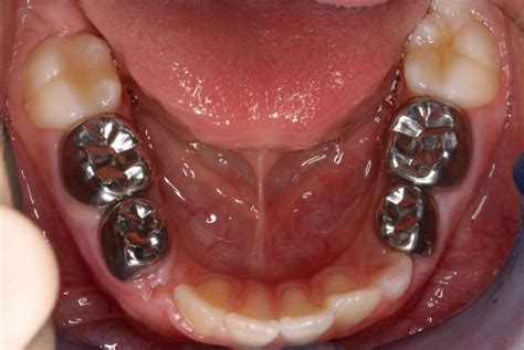 Pin on Dental Conditions