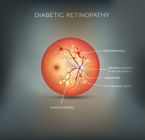 What is Diabetic Retinopathy and what are the best treatment options?