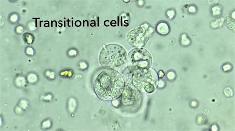 Transitional epithelial cells in urine - YouTube