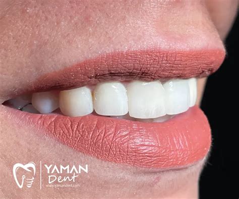 Teeth Whitening Turkey: Price & Procedures | Yaman Dent