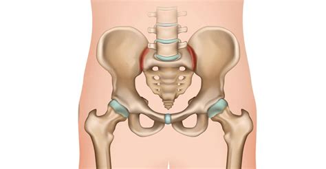 LinQ™ - Sacroiliac Joint Fusion System: SAPNA: Spine and Pain Clinic of ...