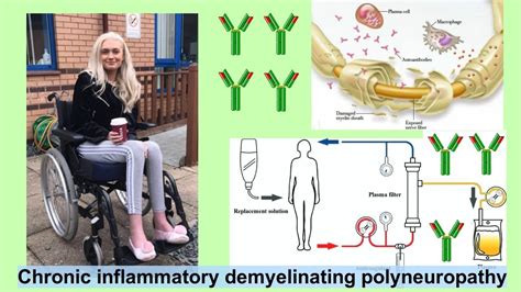 chronic inflammatory demyelinating polyneuropathy - YouTube