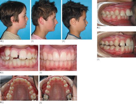 22 Class II division 1 malocclusion | Pocket Dentistry