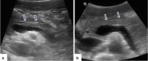 Normal Pancreas Ultrasound