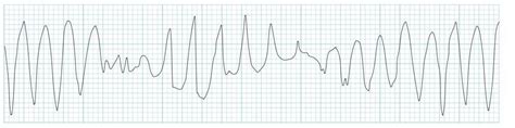 Polymorphic VT and Torsades de Pointes (TdP) • LITFL