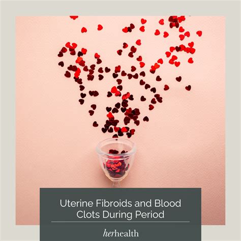 Uterine Fibroids and Blood Clots During Period