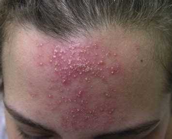 Demodex Folliculitis - Journal of Pediatric and Adolescent Gynecology