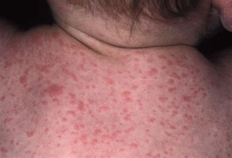 Roseola Rash - Pictures, Symptoms, Causes, Treatment, Home remedies