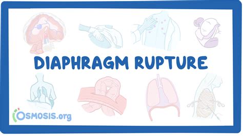 Rupture of diaphragm: Nursing: Video & Causes | Osmosis