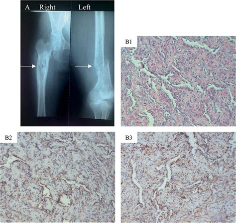 Imaging and pathology. (A) X-ray of the bilateral femurs revealed a... | Download Scientific Diagram