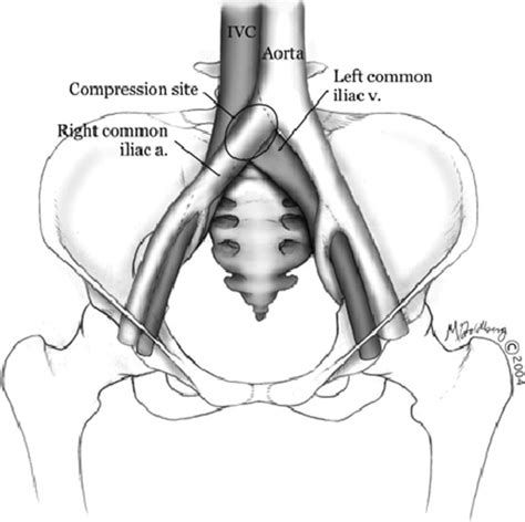 Iliac vein compression syndrome: An underdiagnosed cause of lower extremity deep venous ...