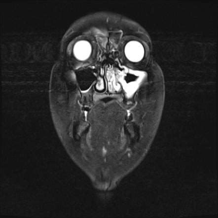 Inverted papilloma | Image | Radiopaedia.org