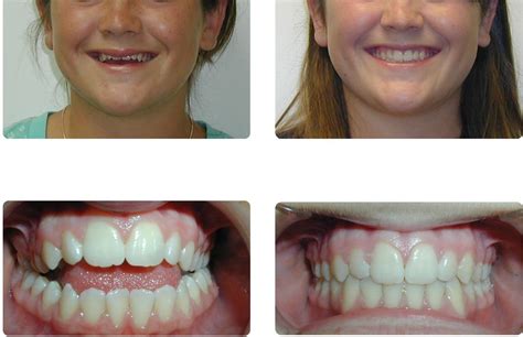 Orthodontic Before and After Photos | Brodsky Orthodontics