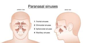 What is a Maxillary Sinus Retention Cyst?