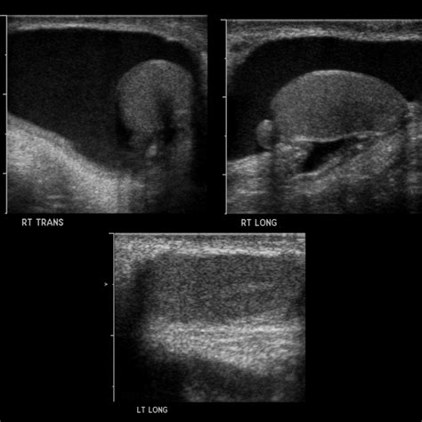 Pediatric Hydrocele | Pediatric Radiology Reference Article | Pediatric Imaging | @pedsimaging