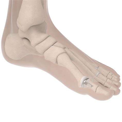 BioPro Hemi Toe Implant for Hallux Rigidus - bioproimplants.com