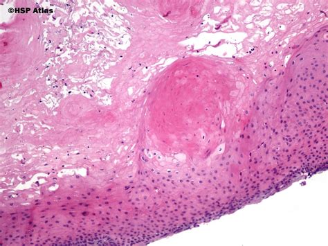 Pilar Cyst Histology