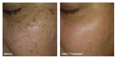 Fade Skin, Dark Spots On Face, Wrinkle Repair, Ipl Laser, Cosmetic Procedures, Laser Treatment ...