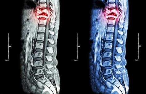 What Are the Different Types of Minimally Invasive Spine Surgery?