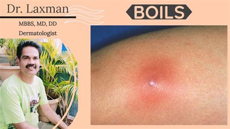 Why Do We Get Boils? | Boil | Pyoderma | Carbuncle | Furuncle | Cure ...