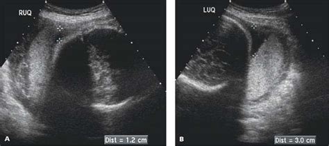 Amniotic Fluid | Radiology Key