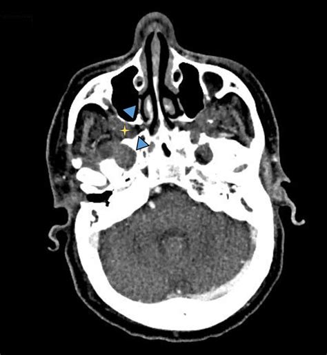 -Enlarged pterygopalatine fossa. Axial CT in soft tissue window ...