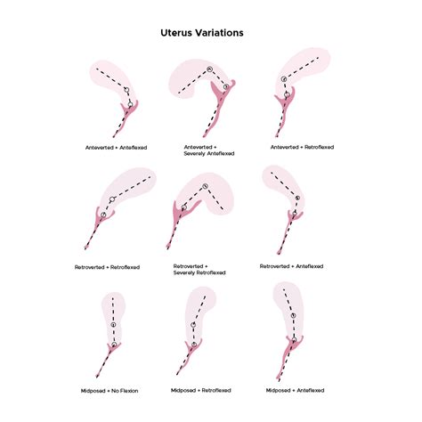 Uterus variations : r/UterusProblems