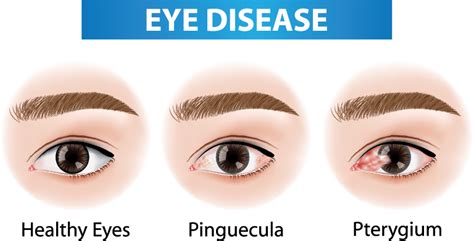 Pterygium/ Pinguecula - Paul Harvey Optometry