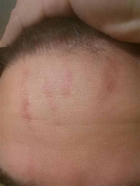 Red Streaks on Forehead - show up randomly. Go away after about a day. Any ideas on what is ...