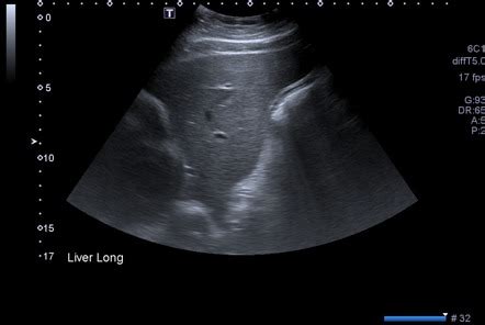 Normal Liver Ultrasound