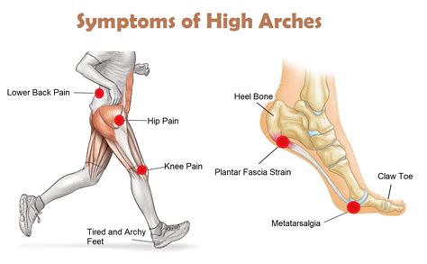 Best Orthotic Insoles for High Arches