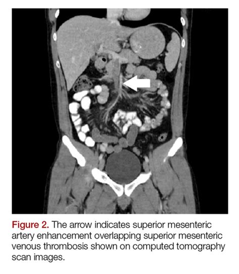 Acute Superior Mesenteric Venous Thrombosis in a Young Patient Without Risk Factors | MDedge ...