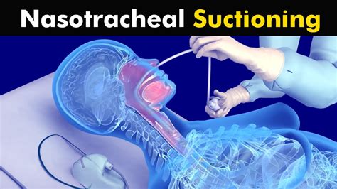 How Nasotracheal suction is performed? - YouTube