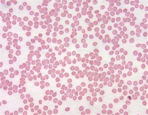 Blood smear of healthy patient