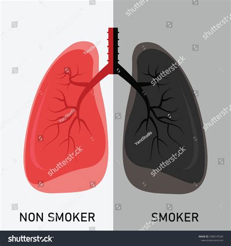 Smoke Vape Causes Lung Disease E-cigarette Stock Vector (Royalty Free) 1580147245 | Shutterstock