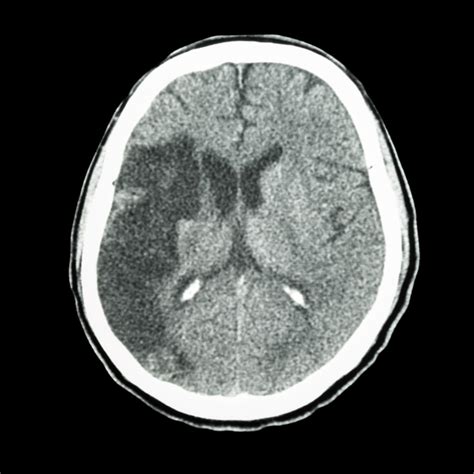 Tenecteplase Appears Superior to Alteplase After Ischemic Stroke - The Cardiology Advisor