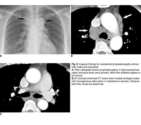 Hilar Lymphadenopathy Ct Scan