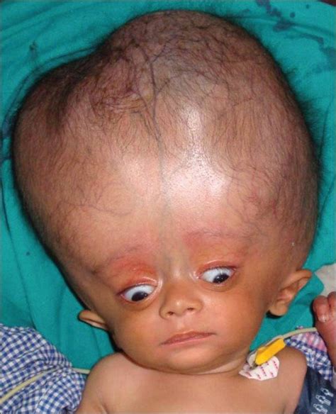 Hydrocephalus with increased head circumference in a 3-month-old child | Download Scientific Diagram