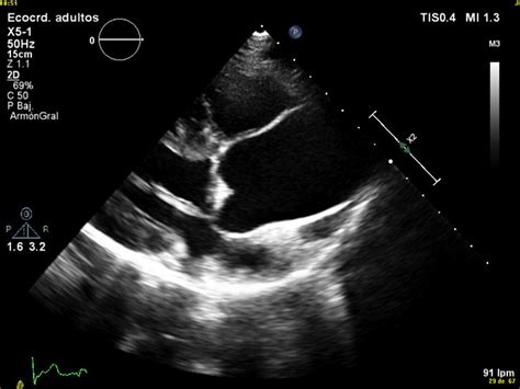 Transthoracic echocardiogram. Dilatation of tubular ascending aorta ...