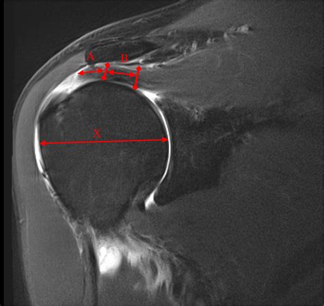 Rotator Cuff Tear Mri